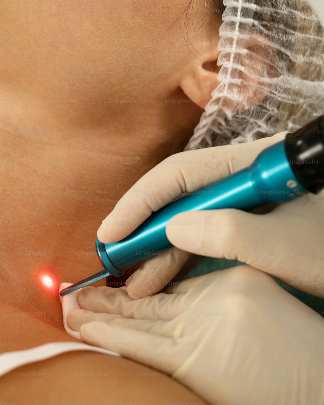Fractional laser resurfacing being performed on a patient's neck and shoulder area